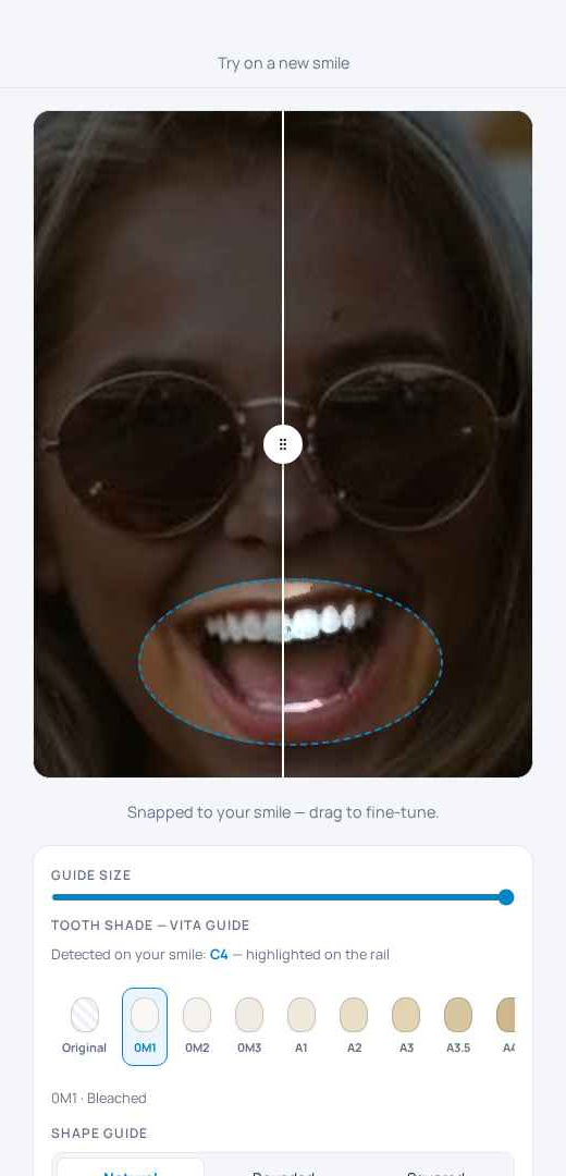 SmileCast split view — before and after whitening side by side
